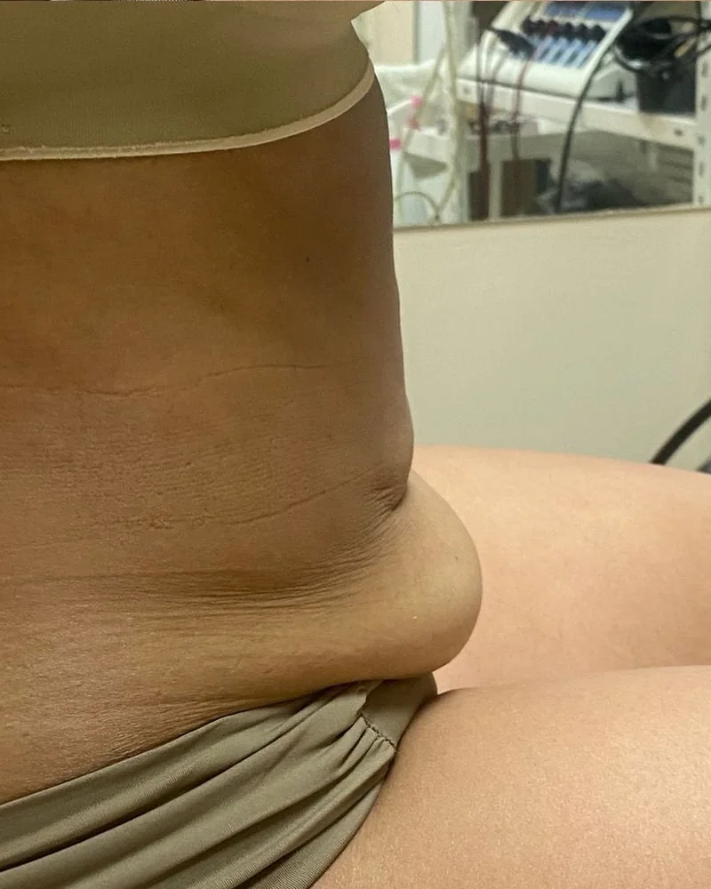 Tratamento corporal: contorno do abdómen (depois)