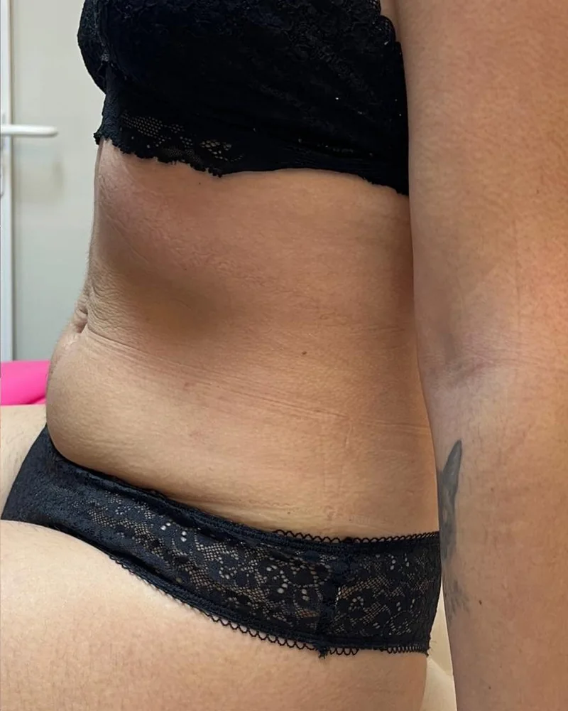 Tratamento corporal, resultado 10 (depois)