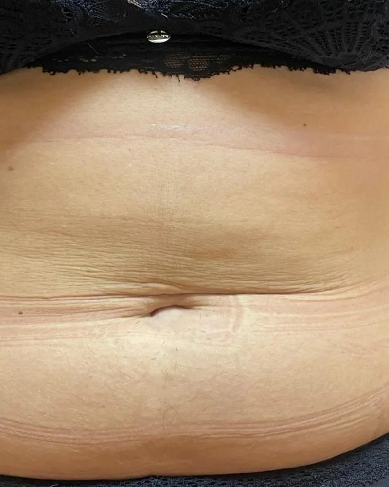 Tratamento corporal, resultado 11 (depois)