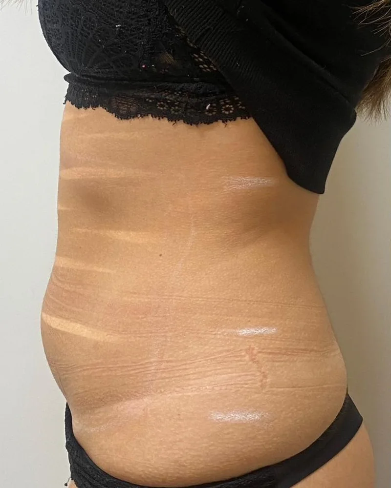 Tratamento corporal: perfil do abdómen e da cintura (antes)