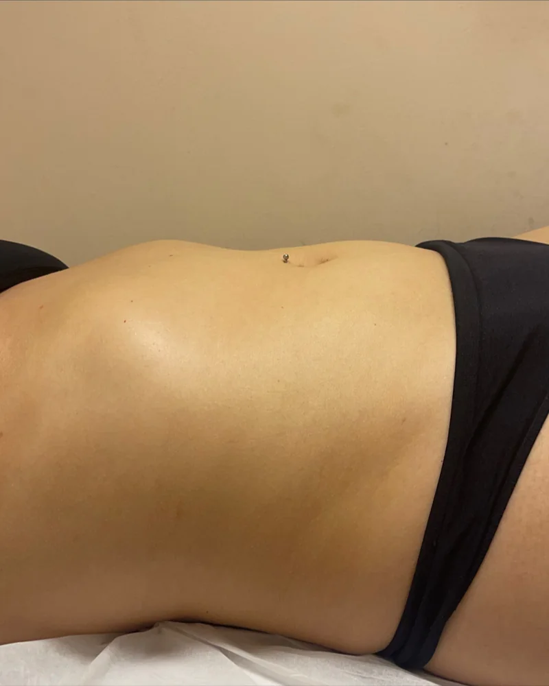 Tratamento corporal, resultado 6 (depois)