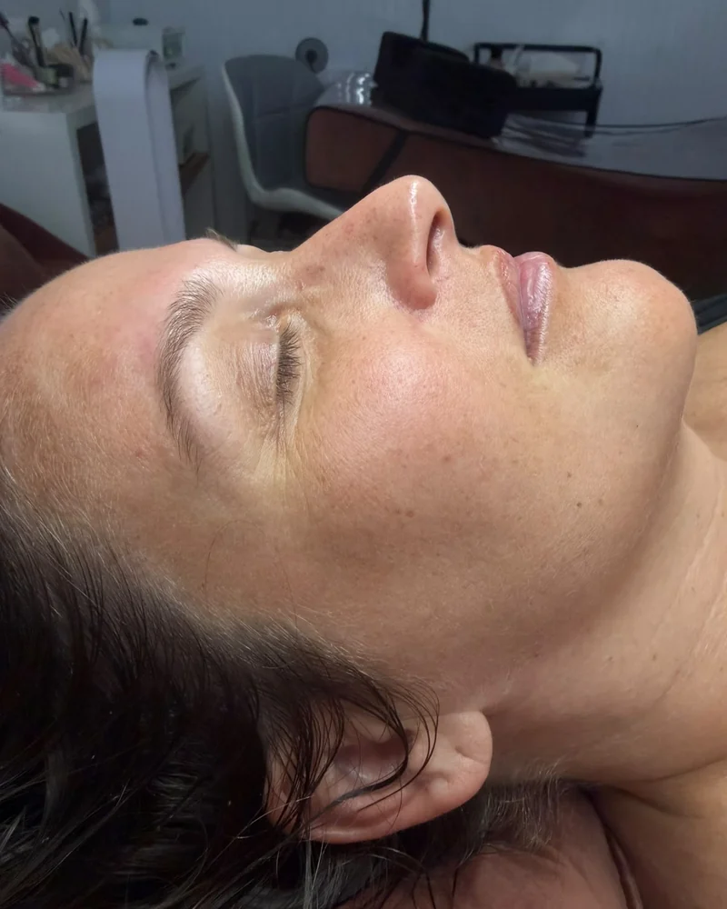 Tratamento facial: pele mais uniforme e luminosa (antes)