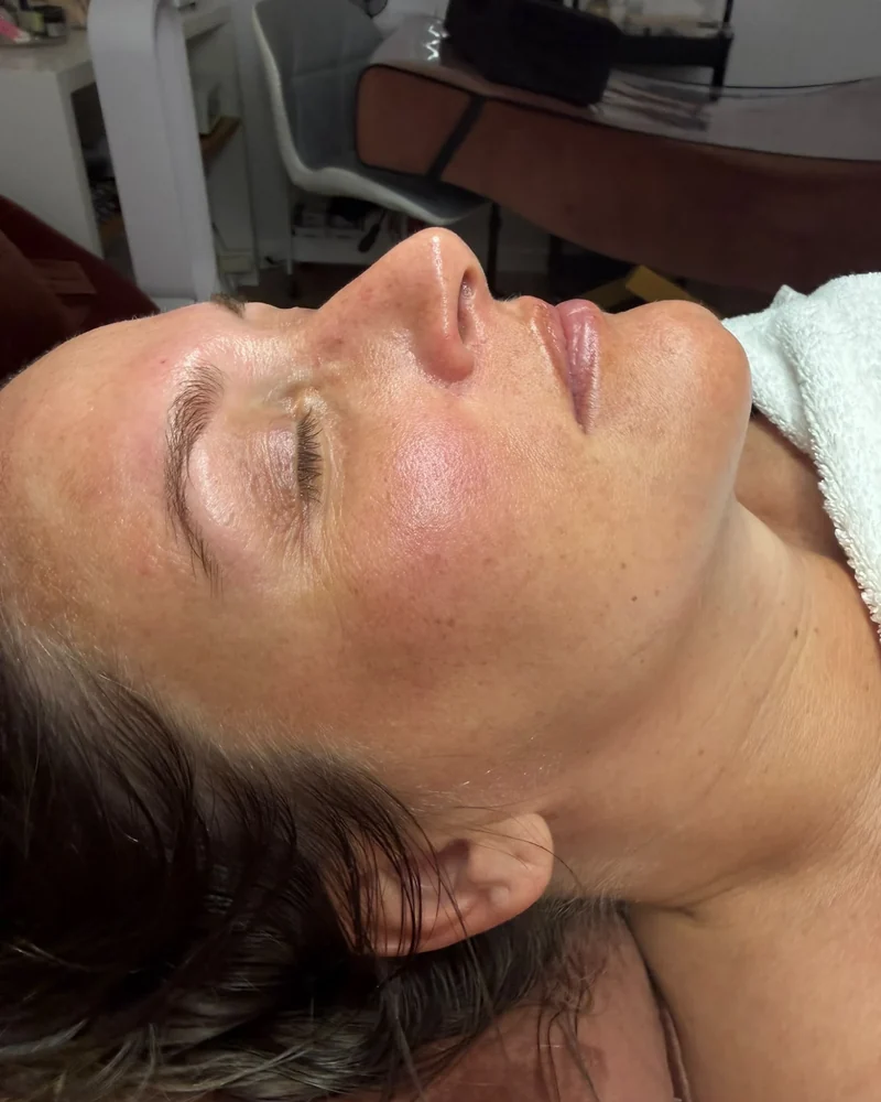 Tratamento facial: pele mais uniforme e luminosa (depois)