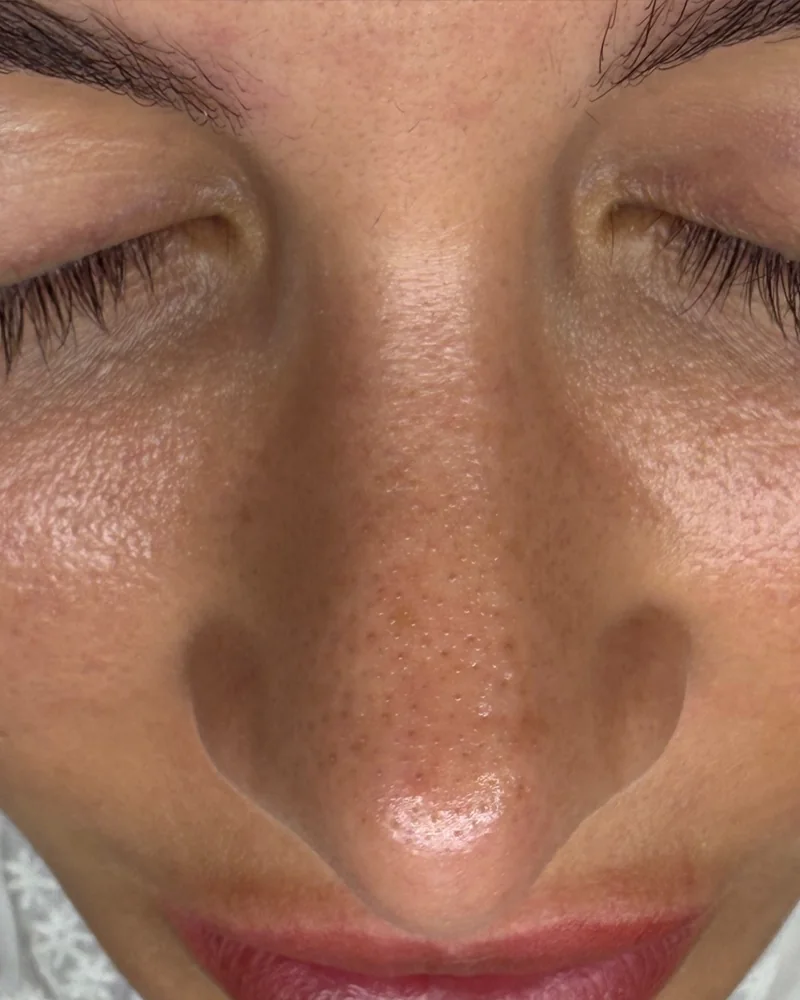 Tratamento facial: pele mais uniforme e luminosa (antes)