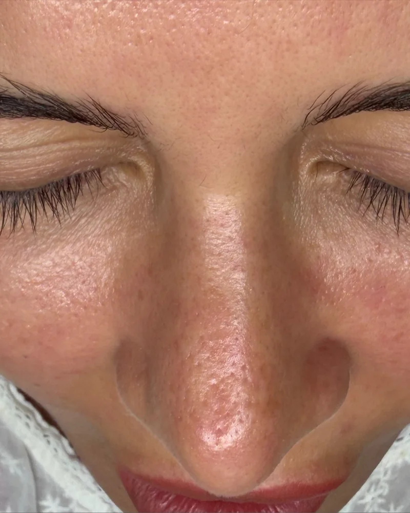 Tratamento facial: pele mais uniforme e luminosa (depois)