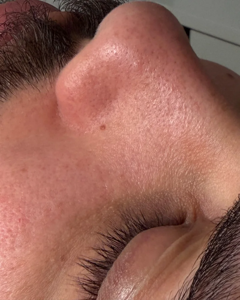 Tratamento facial: pele mais uniforme e luminosa (antes)
