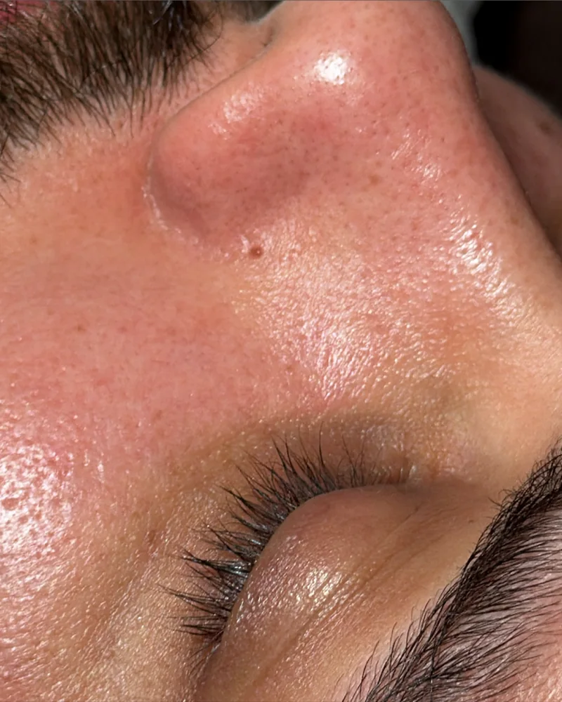 Tratamento facial: pele mais uniforme e luminosa (depois)