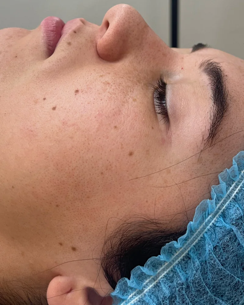 Tratamento facial: pele mais luminosa (antes)