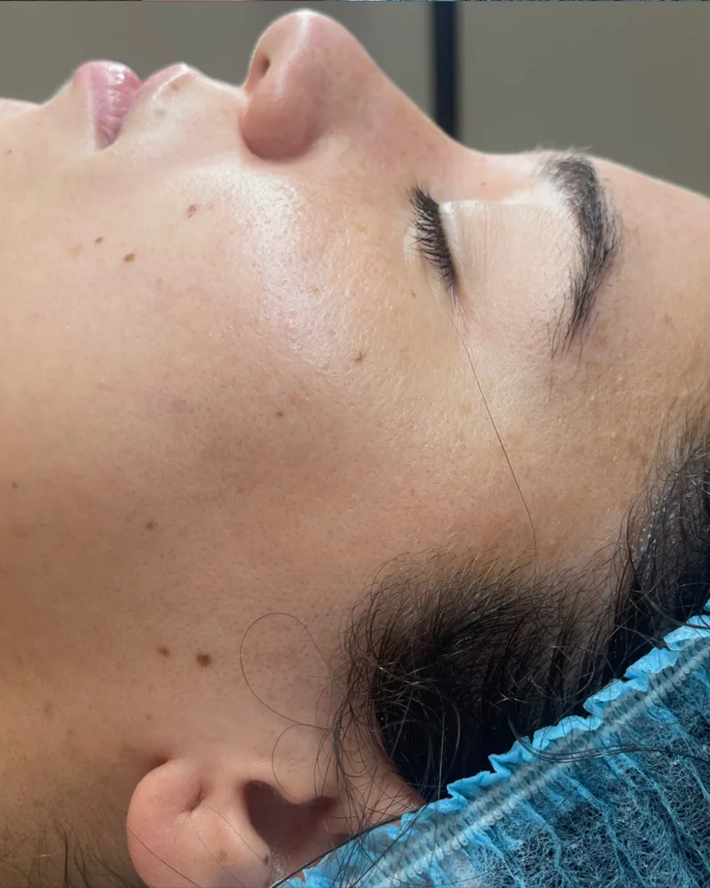 Tratamento facial: pele mais luminosa (depois)